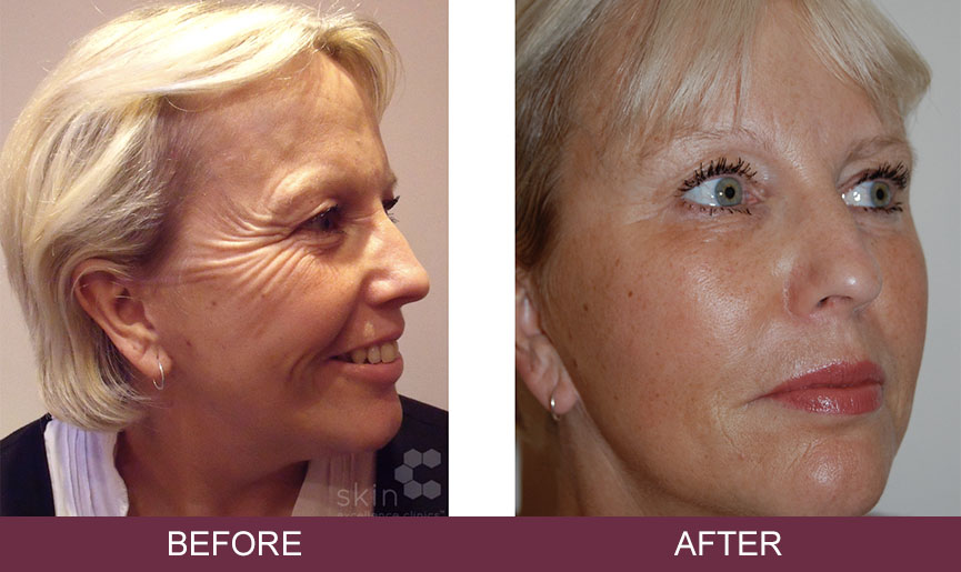 Showing a before and after of a client having Sculptra